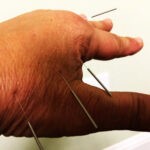 Shirley McWilliams Acupuncture