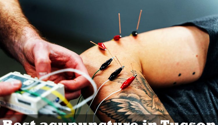 Best acupuncture in Tucson