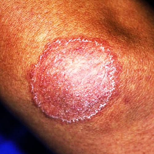 Best Ways to Clear Nail Polish Ringworm [in 4 weeks]