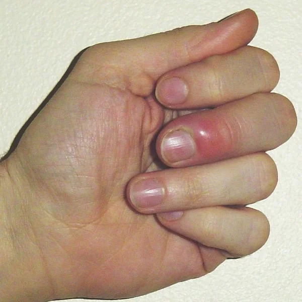 Does bleeding is a side effect of manicures?